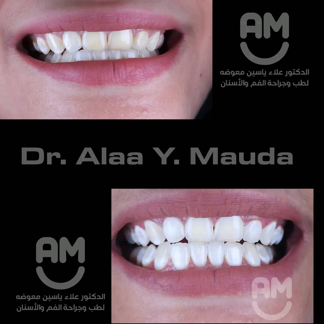 نتائج تبييض الأسنان بالليزر