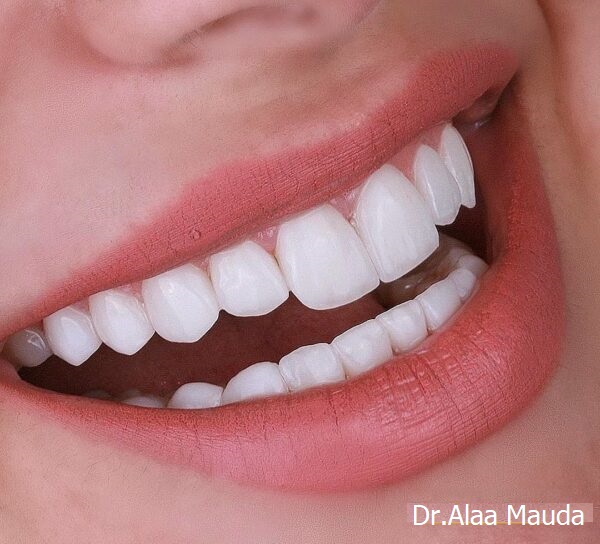 نتائج فينير الأسنان قبل وبعد العلاج