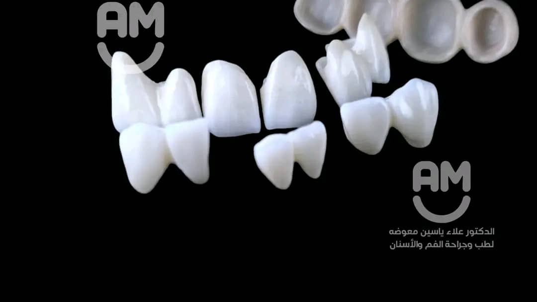 نتائج تركيب زيركون قبل وبعد العلاج